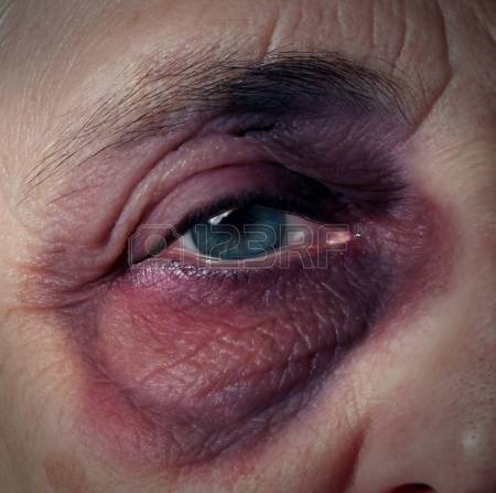 black-eye-bruised-and-injured-from-domest